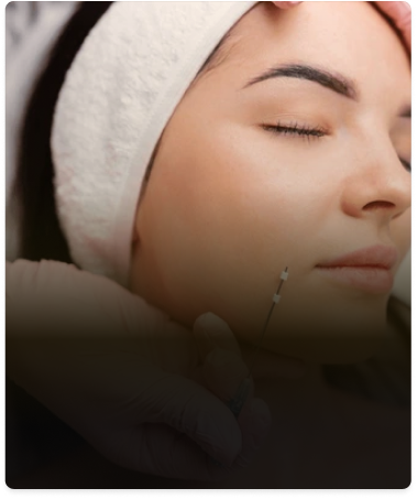 Picture about Collagen Thread treatment (also known as thread lifting or skin boosting threads) uses ultra-fine biocompatible threads — typically made from