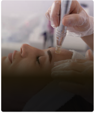 Picture about Microneedling and Active Boost