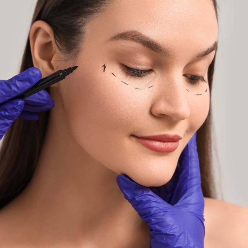 Blepharoplastik mit CO2-Laser (6)